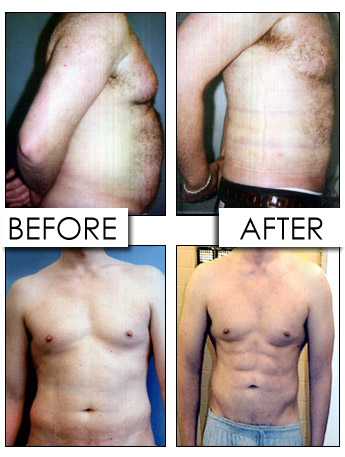 precise-liposuction precise-liposuction
