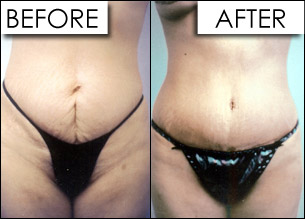 tummy-tuck-surgery tummy-tuck-surgery