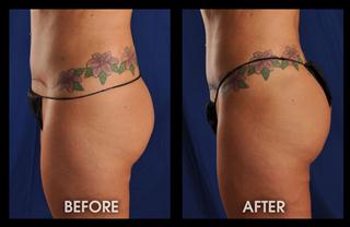 3-months-fat-transfer-and-lipo-hips_Mobile 3-months-fat-transfer-and-lipo-hips_Mobile