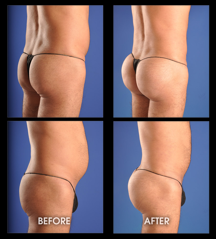 Butt Augmentation Fat 35