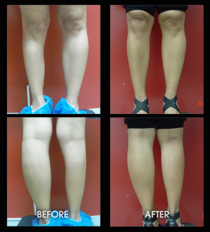 implants calf before implant female cosmetic surgery leg calves augmentation foot club left male yo placement drchugay
