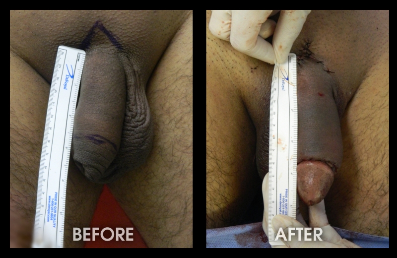 Before And After Pics Of Penis Enlargement 49
