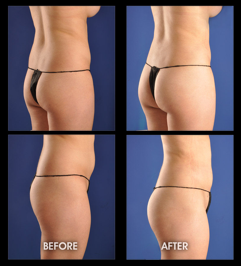 Liposuction Butt 85