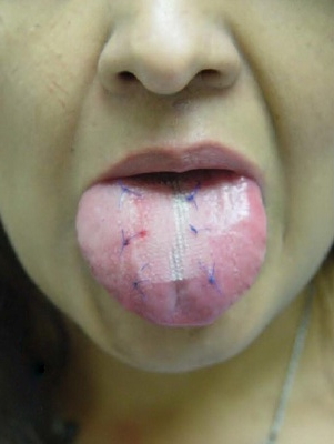 The Tongue patch weight loss procedure, pioneered by Dr. Nikolas Chugay of Chugay Cosmetic Surgical Clinic