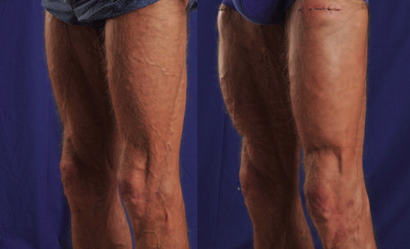 figure6-quadriceps-implant