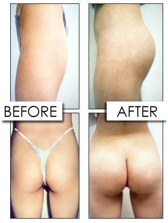 Buttock Augmentation Surgery