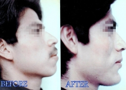 Chin Sculpting Surgery