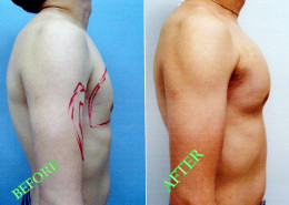 Pectoral Implants