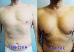 Pectoral Implants