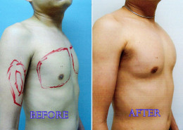 Pectoral Implants
