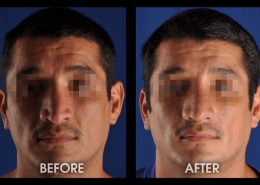 Nose Sculpting Surgery