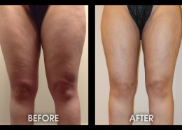 Liposuction