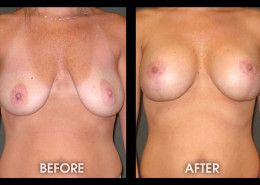 Breast Lift With Augmentation