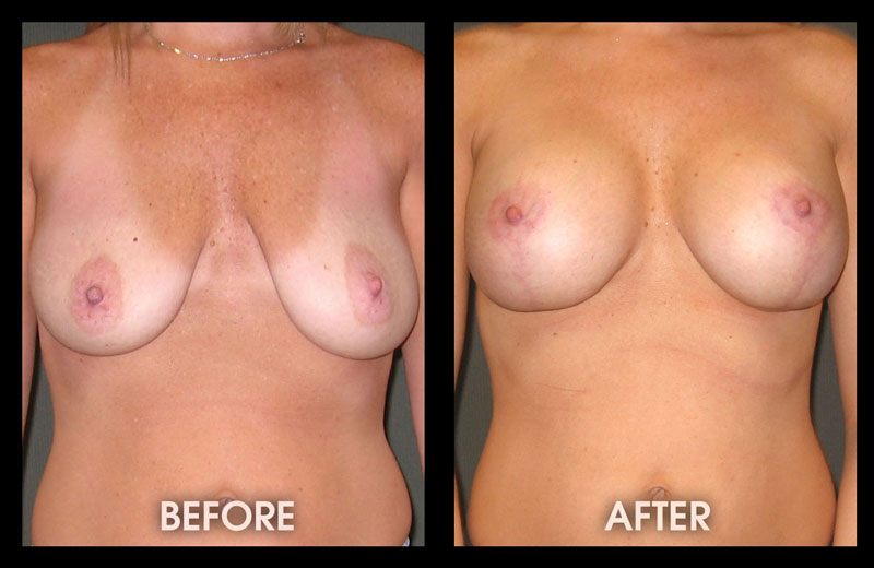 Breast enlarge surgery - Nude pics