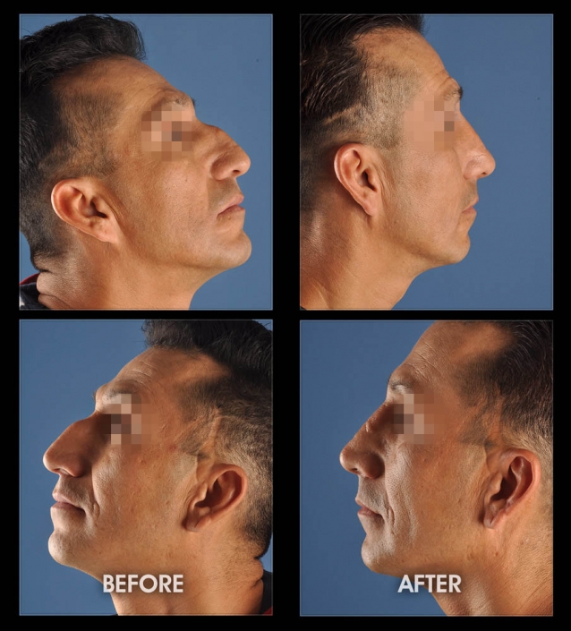 Nose Sculpting Surgery | Performed by Dr. Chugay | Long Beach | Hollywood | CA