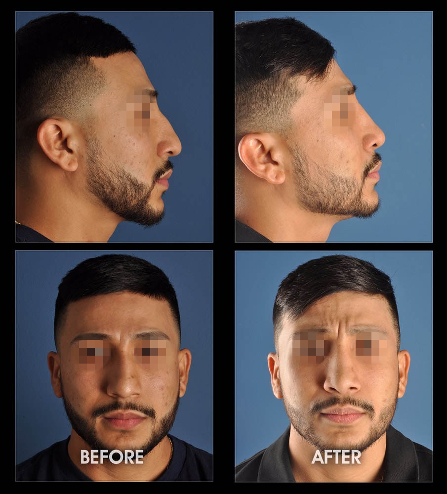 Rhinoplasty