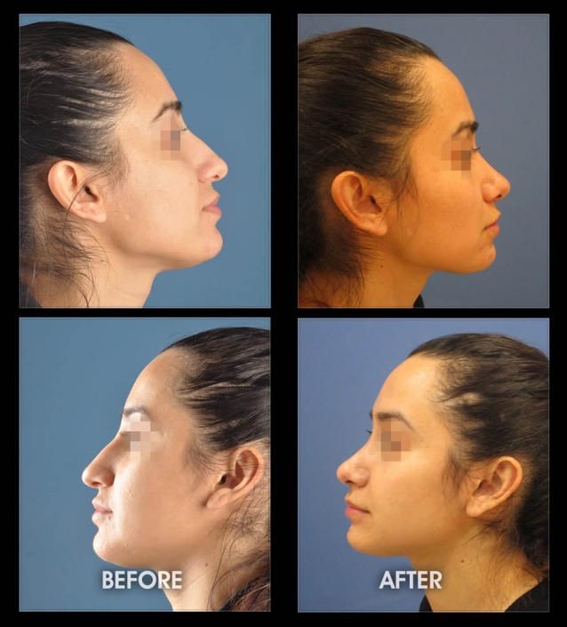 Nose Sculpting Surgery | Performed by Dr. Chugay | Long Beach | Hollywood | CA