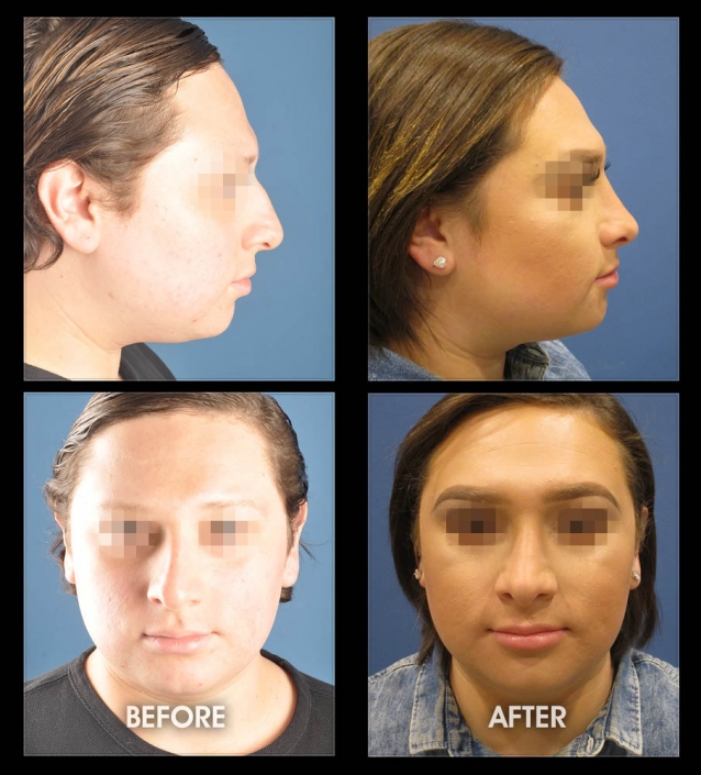 Facial Feminization Cosmetic Procedure, Rhinoplasty, Before and After