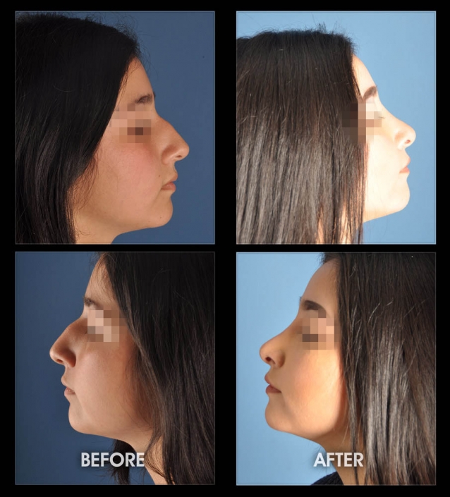 Nose Sculpting Surgery | Performed by Dr. Chugay | Long Beach | Hollywood | CA