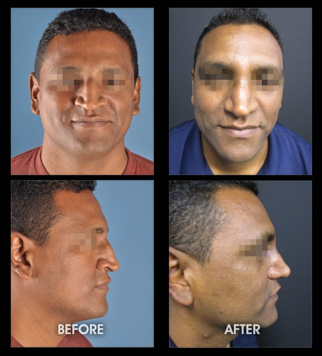 Nose Sculpting Surgery | Performed by Dr. Chugay | Long Beach | Hollywood | CA