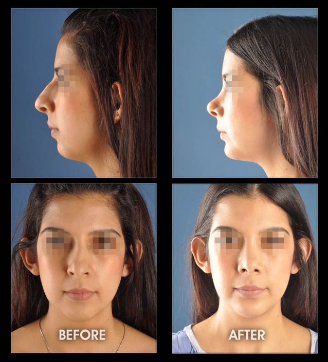 Nose Sculpting Surgery | Performed by Dr. Chugay | Long Beach | Hollywood | CA