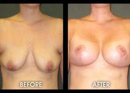 Breast Lift With Augmentation