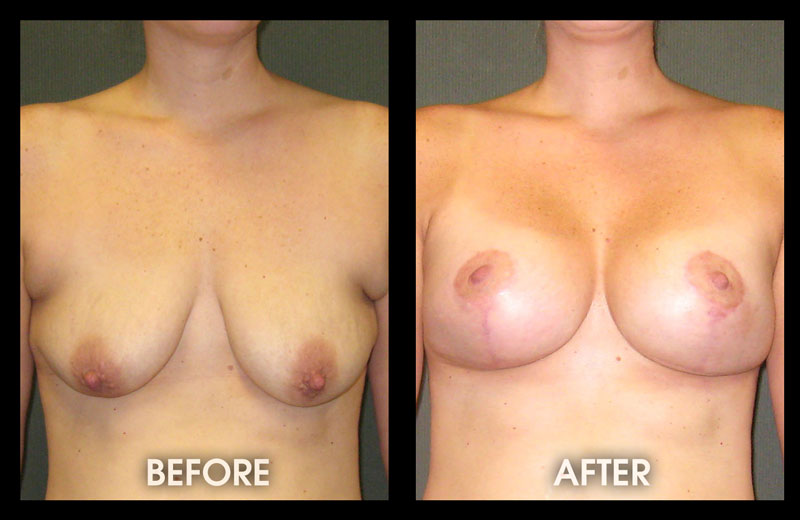 Breast Lift With Augmentation