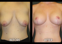 Breast Lift With Augmentation