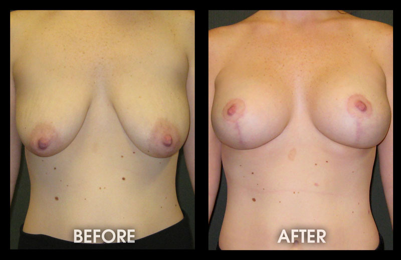 Breast Lift With Augmentation