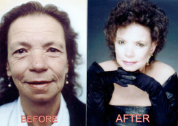 Vertical Facelift