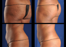 Buttock Augmentation