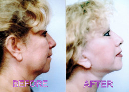 Vertical Facelift