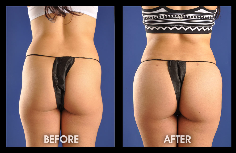 a woman wearing thongs before and after