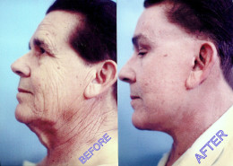 Vertical Facelift