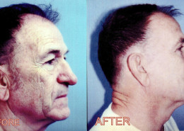 Vertical Facelift