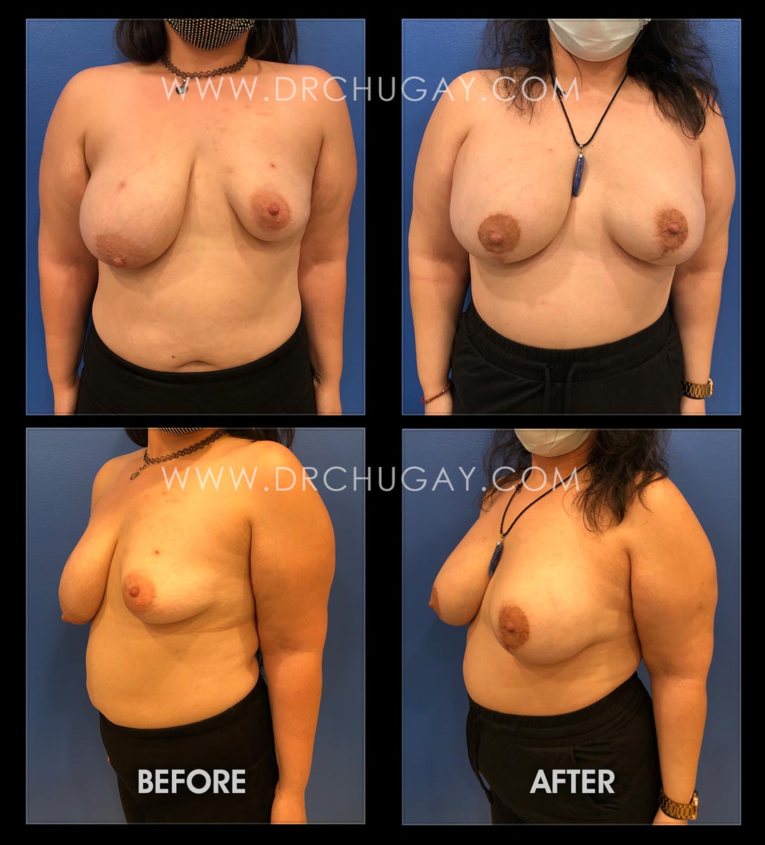 Breast Augmentation