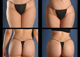 Hip and Thigh Augmentation Before and After Gallery Long Beach CA