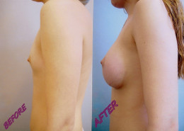 Breast Implants