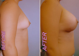 Breast Implants