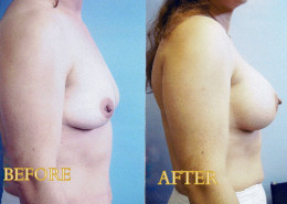Breast Augmentation
