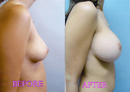 Breast Implants