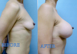 Breast Implants
