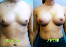 Breast Implants
