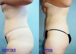 Liposuction