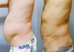Liposuction