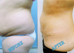 Liposuction