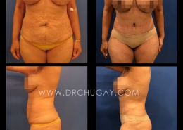 46yo female G2P2 (2 children) before and 4 months after abdominoplasty with liposuction of the flanks. A 7cm diastasis (muscle separation) was repaired. 4lb 4oz abdominal flap of tissue was removed. 2300cc of total aspirate was noted from the waist and flanks. Note: The patient has significant stretch marks above the belly button that could not fully be removed with the abdominoplasty procedure and was made aware of this limitation preop