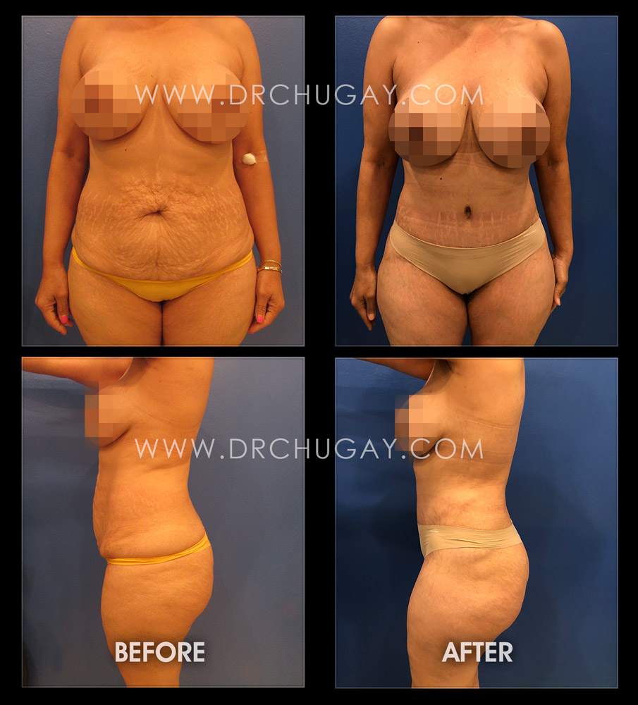 46yo female G2P2 (2 children) before and 4 months after abdominoplasty with liposuction of the flanks. A 7cm diastasis (muscle separation) was repaired. 4lb 4oz abdominal flap of tissue was removed. 2300cc of total aspirate was noted from the waist and flanks. Note: The patient has significant stretch marks above the belly button that could not fully be removed with the abdominoplasty procedure and was made aware of this limitation preop