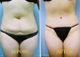 Tummy Tuck