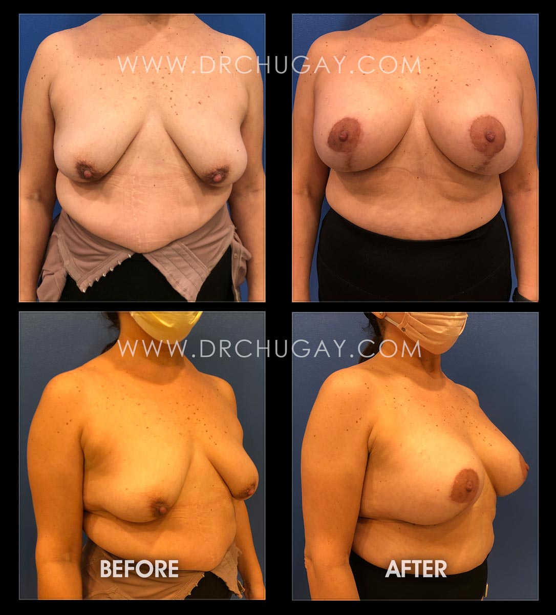 Breast Augmentation